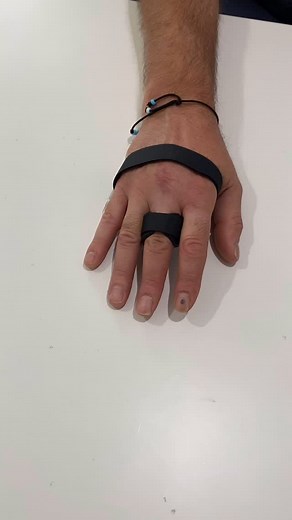 Check out this moneybag splint made by our hand therapist Naomi! Typically indicated for trigger finger, the splint is designed to limit movement at the MCPJ and therefore, avoid triggering and help rest the irritated flexor tendon. Our hand therapists work with you to create splints that are customised to your hand so you’re more likely to wear them! ✋🏻🤓 If you need a splint, give us a ring on 61435730051. #handinhandrehab #handtherapy #handrehab #splints #handsplints #customisedsplints #mone