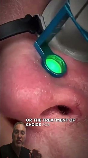 Best Treatment for Facial Broken Capillaries