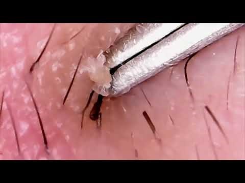 INGROWN HAIR Removal 😲 Infected Ingrown Hairs