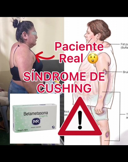 Síndrome de Cushing 🫣 #estudiantedemedicina #medicina #doctor
