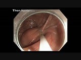 Colonoscopy Channel - Ligation of a Giant Colon Lipoma • Video • MEDtube.net