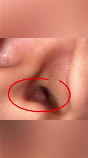 Mupirocin Ointment 2% for folliculitis | Please consult doctor before using