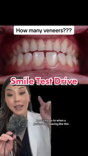 I love doing these “Smile Test Drives”. It allows us to get on the same page and for a patient to visually see what small adjustments can look like in their smile. Seeing is believing! #veneers #smilemakeover