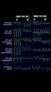 Wide QRS Tachycardia 1️⃣ Ventricular tachycardia (VT) 2️⃣ SVT with aberrancy 3️⃣ SVT with preexcitation (WPW) 4️⃣ SVT with baseline abnormal ECG 5️⃣ SVT with hyperkalemia 6️⃣ Ventricular pacing #WideQRSTachycardia #Cardiology #ECG #VTach #SVT #MedEd #CardiacElectrophysiology #ACLS | Abdallah Othman