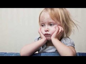 Measles - Akron Children's Hospital video