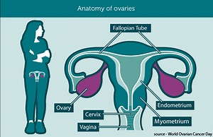 What is ovarian cancer?