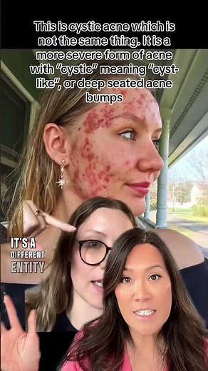 Cystic Acne vs Epidermoid Cyst