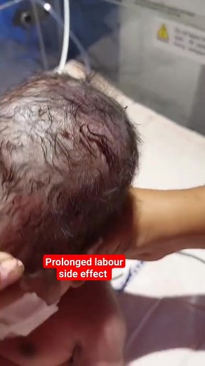 10K views · 31 reactions | prolonged labour effect | We Love Babies | Facebook