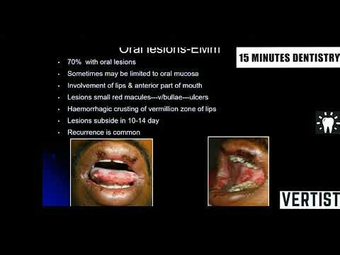 Pemphigus vs Erythema Multiforme Which Skin Condition is WORSE