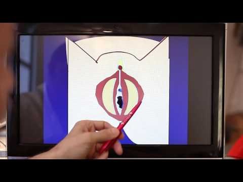 Labiaplasty: Labia Reduction Surgery 2