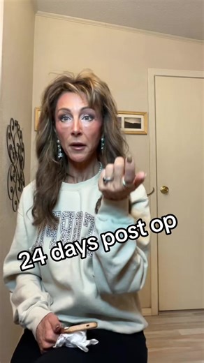 Lower Blepharoplasty Recovery at 24 Days Post-Op