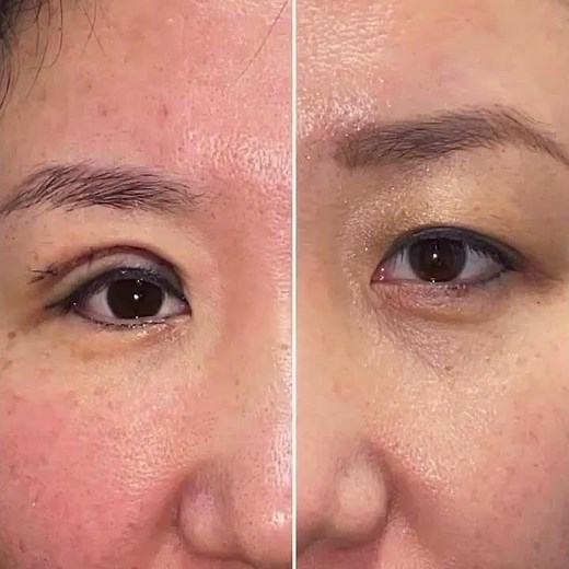 Asian Upper Blepharoplasty Before and After | Eyelid Center of Utah | Dr. Kian Eftekhari