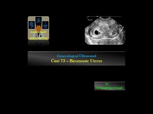 Ultrasound Case 73 -Bicornuate Uterus