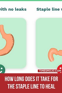 How long does it take for the staple line to heal after gastric sleeve? - TimesMojo