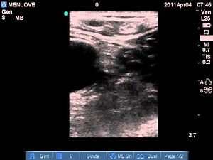 Normal - Inguinal Lymph Node