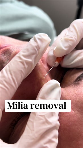 Understanding Milia and Their Professional Removal