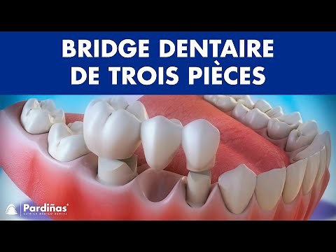 Bridge dentaire de trois pièces ©