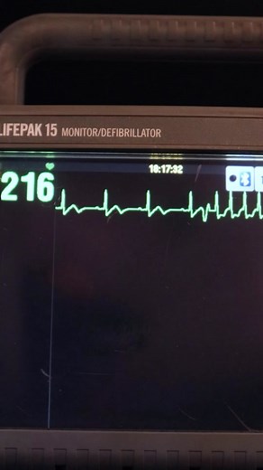 Understanding SVT on ECG: Part 2 Treatments Revealed!