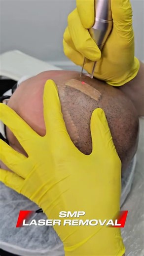 First session Laser SMP removal! Over saturated botched SMP is almost gone #smpremoval #removesmp