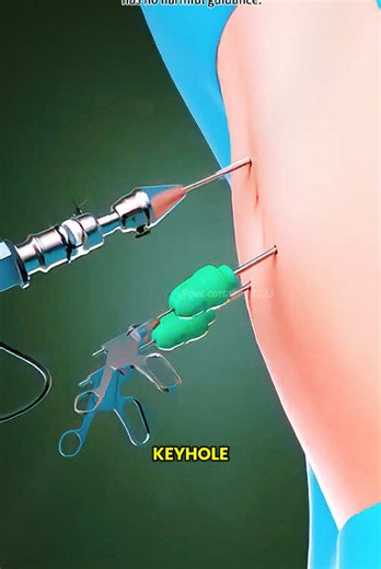 Appendectomy procedure(3D Animation) #3dmedical #3de #3dmedicalanimation #3dmedicalvideo #appendectomy #appendectomyrecovery #appendectomycheck #appendectomyprocedure #appendectomysurgery #appendix