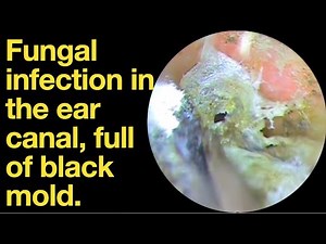 Fungal infection in the ear canal, full of black mold.|ear wax removal | ear cleaning | ASMR