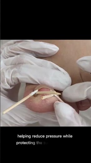 "The future of ingrown toenail treatment? No cutting. No digging. Just acrylic. #toenails #nailtech