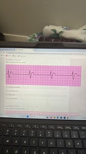 What is the rhythm? Select your answer.Idioventricular Rhythm... | Filo