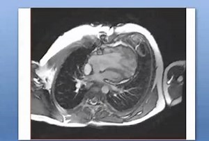 Shone complex. HLHS | Cardiology-Dr.AsifUllah