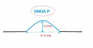 ECG normal (12): Onda P  (duración, voltaje y morfología)