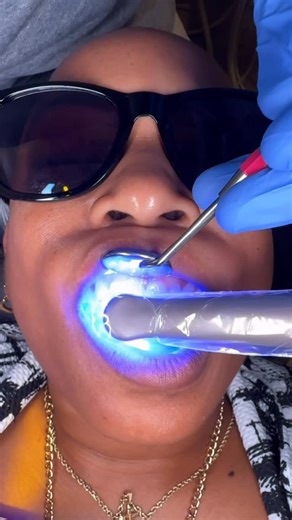 Dr Eric Mee on Instagram: "This is just a quick 15 Min Mock up to help our patient visualize what veneers can do. I know this before/after looks a little funny we do this without drilling the natural teeth or numbing so the colors look uneven in thin areas but mock ups are such an amazing tool to help patients see the impact. This can be done at the consultation in some cases and it’s fast and easy. If you’re interested in improving your smile DM me a pic of your smile and I will send you my sug