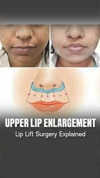 When You Need a Lip Lift Instead of Fillers? Lip Lift Surgery | Lip Augmentation