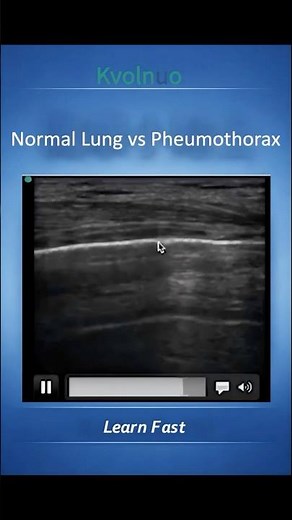 Pneumothorax vs Normal Lung (The Lung Point Trick) #sonography #ultrasound #sonographer
