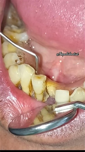 Such tooth mobility and tooth loss can be prevented #preventive #dentistry #tooth #mobility #toothloss #savetooth #dentist #drbiplob #oral #health #awareness #premierdentalnepal #दन्तस्बास्थय #दन्तस्बास्थय