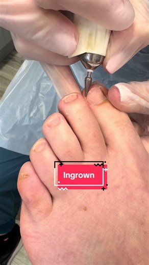 Essential Facts About Ingrown Toenails You Should Know