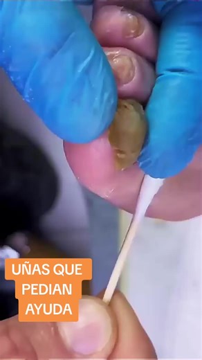 Transformación de Uñas Deplorables a Saludables