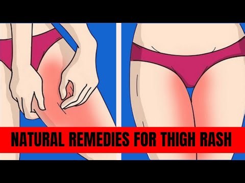 No More Itching & Burning! Inner Thigh Rash Remedies That Work