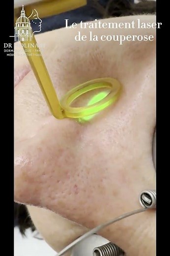 Dr.Molinari : Le traitement de la couperose