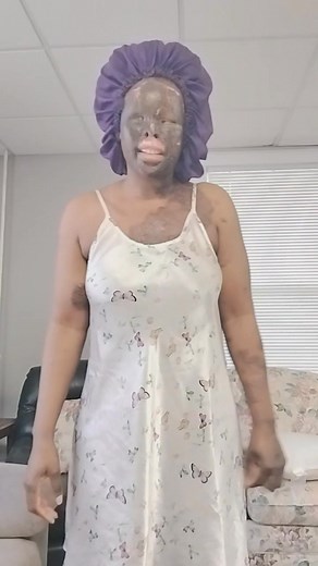 Hello my friends, today I want to show you how big my scar is. Remember 100087166283736:2048:Primrose RuwochaPage is a Survivor of Sulphuric Acid attack through Gender Based Violence Part 10 | Primrose RuwochaPage