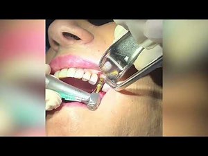 Versah vertical sinus lift with an Astra PrimeTaper implant