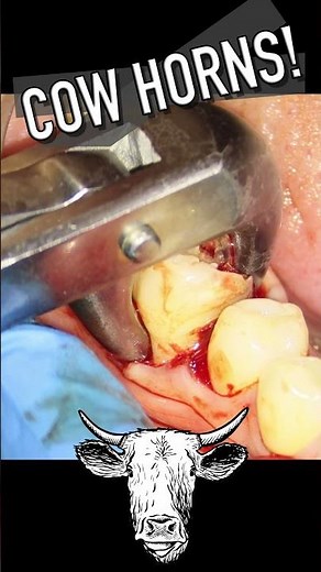 Tooth extraction with Cow Horn forceps | HD resolution