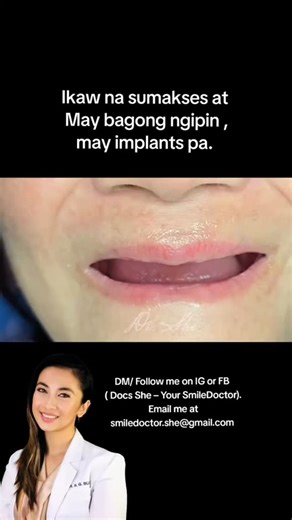Doc She | Your Smile Doctor on Instagram: "A Snap-In Implant Denture may be recommended if you experience any of the following: ✔ Your denture feels loose or slips – Moves when talking, laughing, or eating – Lifts when you open your mouth ➡️ Snap-in dentures lock onto implants, preventing movement. ✔ Your denture feels bulky or thick – Feels heavy or uncomfortable – Affects speech or causes gagging ➡️ Implants provide support, so the denture does not need to be overly bulky. ✔ You rely on dentur
