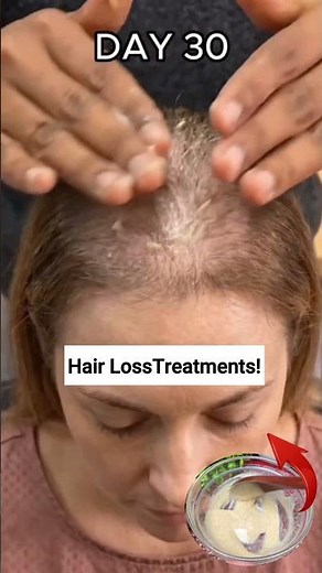 Fix Bald Spots and Regrow Baby Hair at Home 😍✨