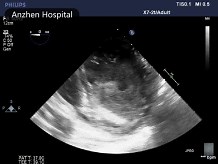 Spontaneous Echo Contrast Mimicking Left Ventricular Thrombus in a Patient on Extracorporeal Membrane Oxygenation Support