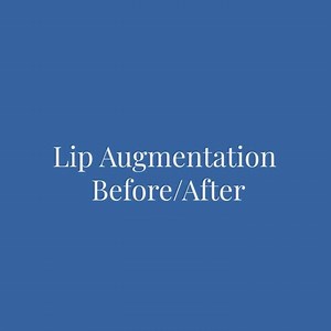 Lip augmentation before/after with natural effect. Let us know your views in the comments below 👇🏻 #lipaugmentation #lipfillers #drramiabadi #cosmeticdermatology | Dr. Rami Abadi Clinics