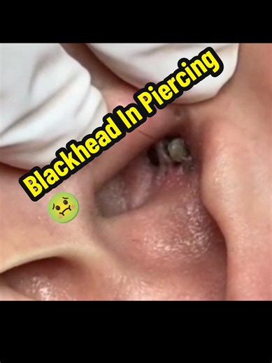 #blackhead #pop #asmr #satisfying #tiktok #pimple #pop #asmr #satisfying #tiktok #blackhead #skincare #popping #wow #video #acne #tiktokviral #real #cool #funny #comedy #ok #silly #america #fun #trending