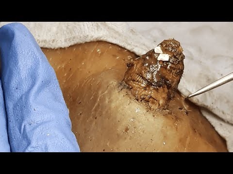 [ASMR] Giant Abscess Pimple Drainage, Most Satisfying Deep Clean Dr. Pimple Popper 2511SS 102033