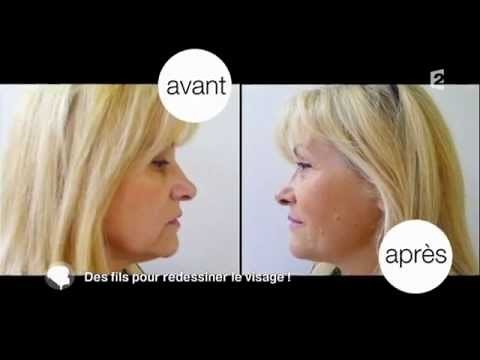 Fils tenseurs par le Dr Peyronnet