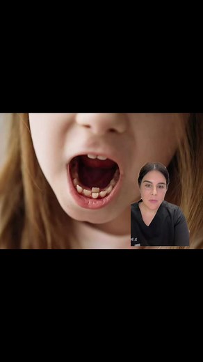 Dealing with Shark Teeth in Kids - Pediatric Dentist Tips