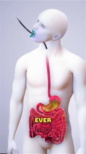 Achalasia Dilation Surgery: Opening a locked esophagus! 🔓 Watch how balloon dilation restores swallowing in this 3D animation. #achalasia #swallowing #gastroenterology #medicalanimation #surgery | Life Health.