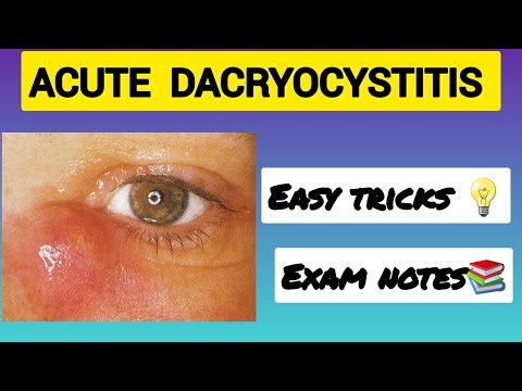 Acute Dacryocystitis | Easy Tricks | #Ophthalmology #Bams